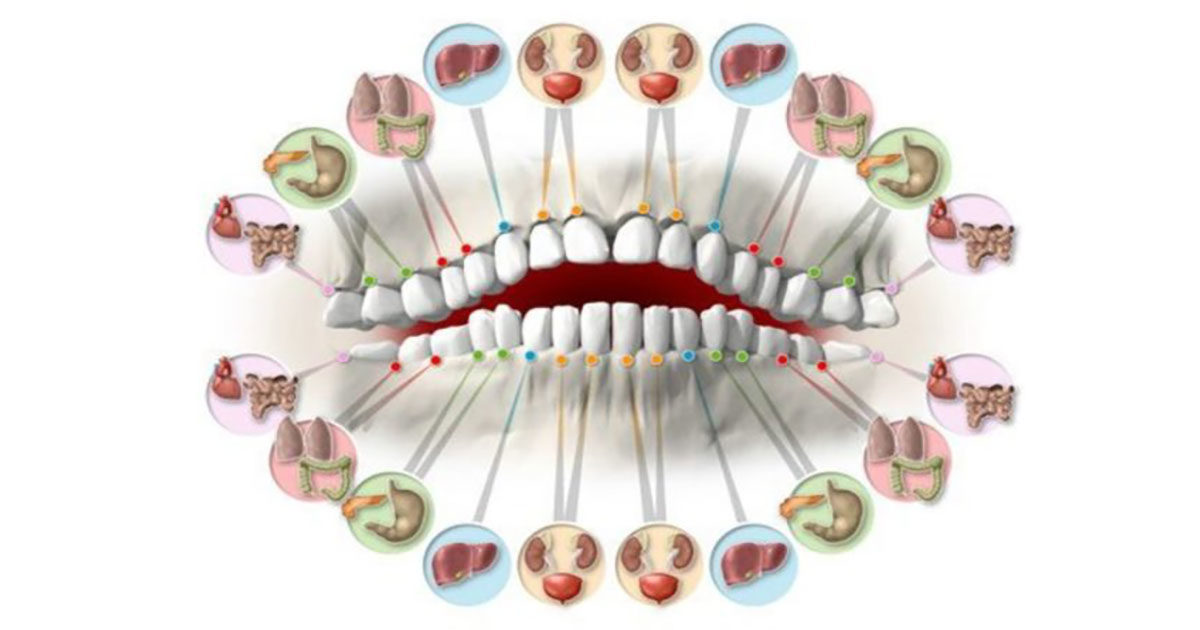 dents