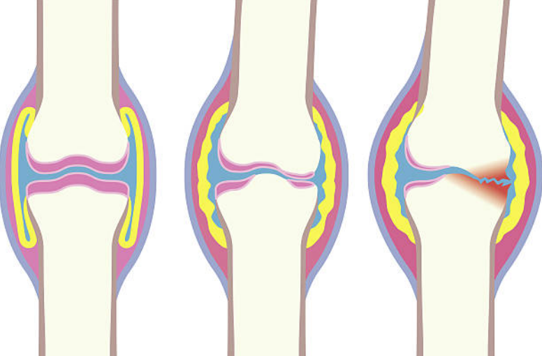 osteoarthritis