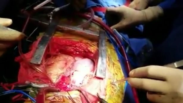 heart transplant