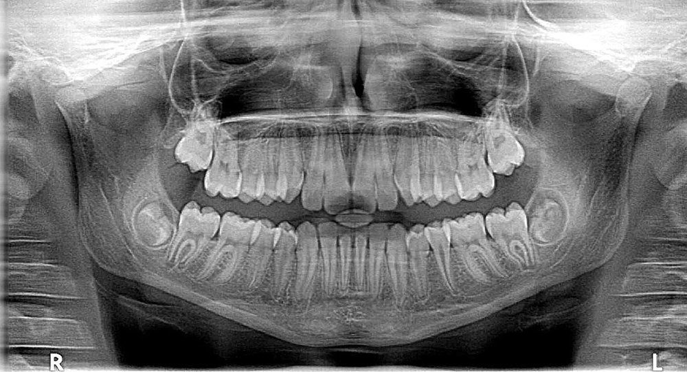 jawbone, x-rays