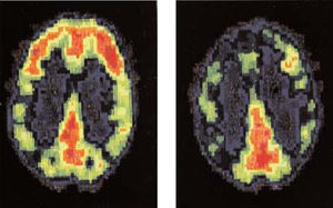 Scan du cerveau d’une personne normale et d’un tueur (à droite), qui montre l’absence d’activation du cortex préfrontal.