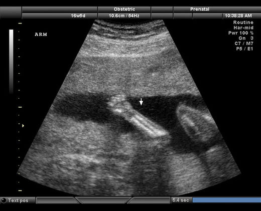 Foetus, echographie